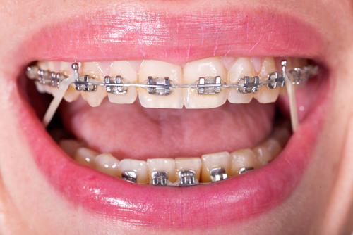 Self-Ligating Orthodontics | Top Orthodontist in Miami, FL