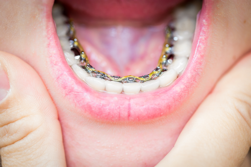 What are Invisible Lingual Braces?